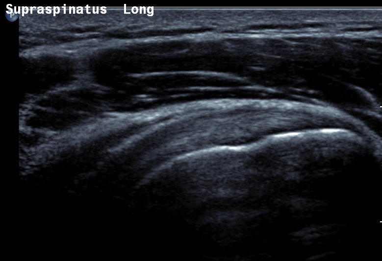 Shoulder Ultrasound Normal Supraspinatous